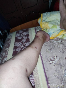 Сбор на протез руки - IMG_20230515_002627.jpg