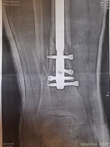 Нужна помощь сыну сотрудницы Не может ходить. - 20230719_135256.jpg