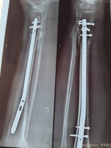 Нужна помощь сыну сотрудницы Не может ходить. - 20230719_135435.jpg