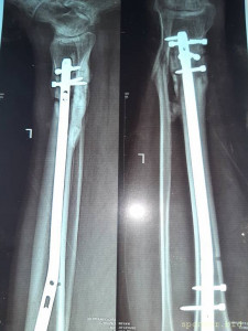 Нужна помощь сыну сотрудницы Не может ходить. - 20230719_135445.jpg