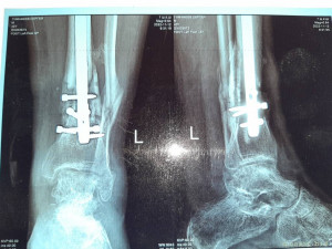 Нужна помощь сыну сотрудницы Не может ходить. - 20230719_135457.jpg