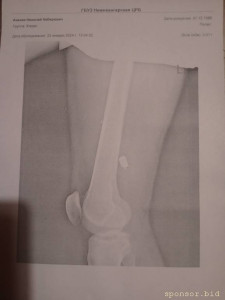 Рентген от 23.01.2024г. В госпитале не доглядели оставили осколок, который доставляет не малый дискомфорт при нагрузке